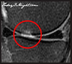 todayimight.com | Knee Injury Leads to Hiatus | Knee Chondral Injury MRI